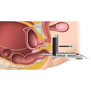 Fusion Βιοψία Προστάτη